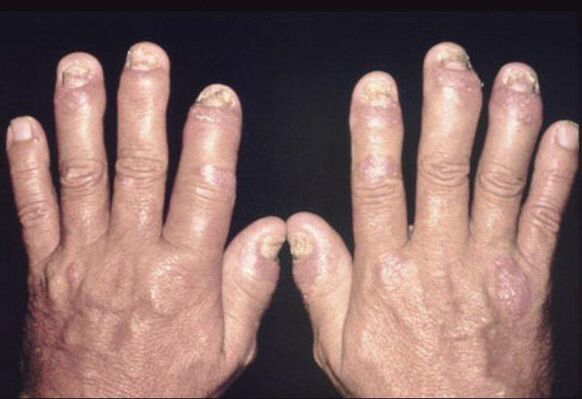 Dans les articulations