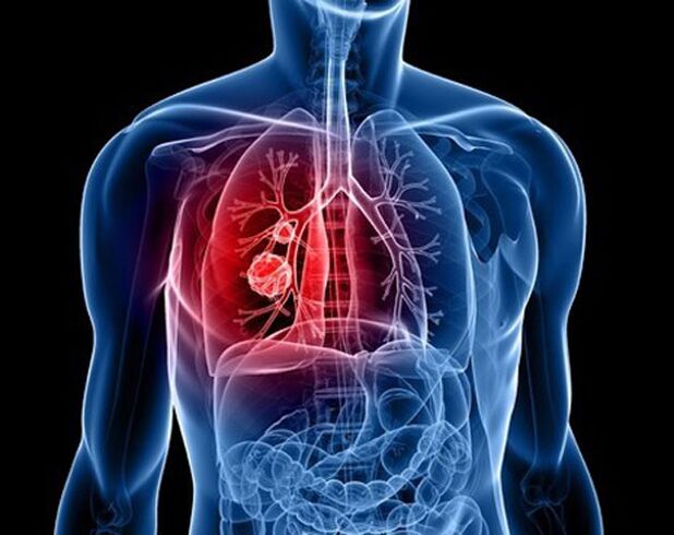 Parasites dans les poumons